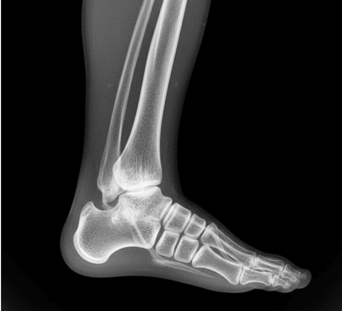 Ankle MRI