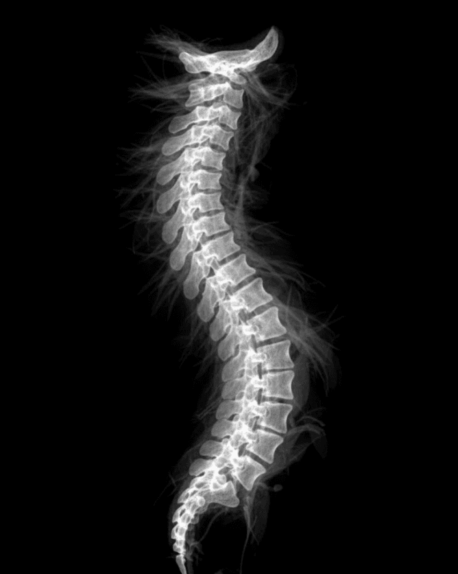 Spine MRI