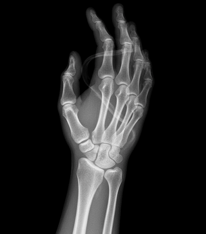Wrist MRI